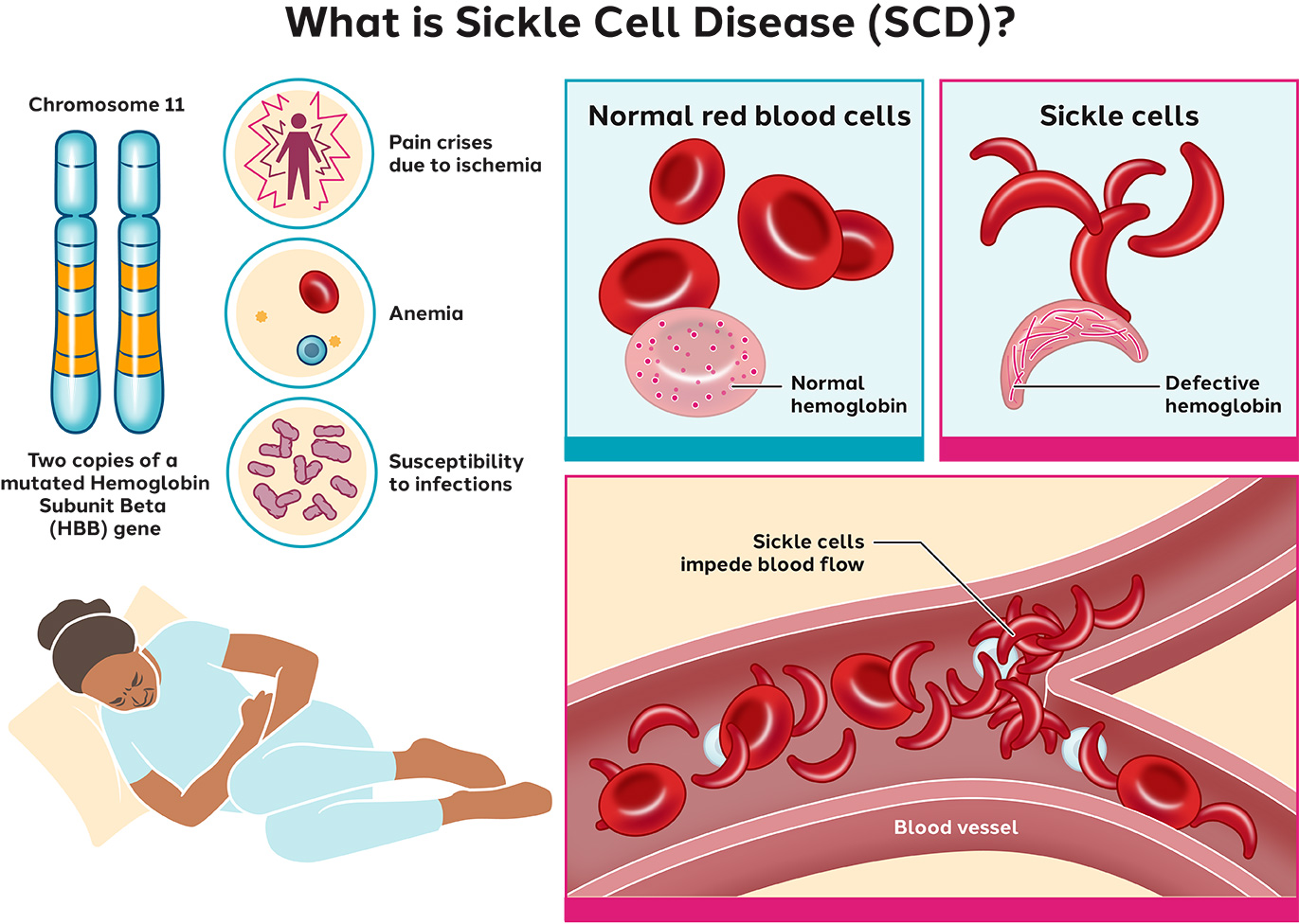 graphic showing what sickle cell disease is